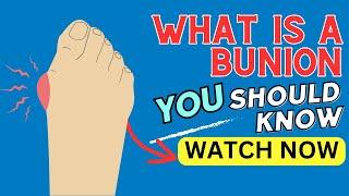 What Is Bunion What Does Bunion Look Like  Definition of Bunion? YOU SHOULD KNOW