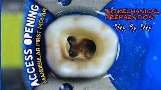 Access Opening Mandibular First Molar  Biomechanical Preparation  step by step