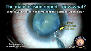 CataractCoach 1507 the main incision ripped - now what?