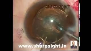 Cionni ring placement for subluxated cataract at sharp sight