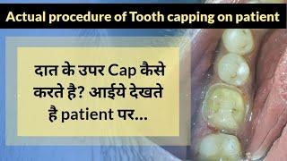 आईए देखते है Tooth Capping कैसे करते है? l Tooth Capping Procedure on patient...