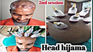 Head hijama therapy 2nd session  hijama therapy for hair fall control and hair regrow