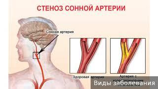 Стеноз сонной артерии. Как лечить стеноз сонной артерии.