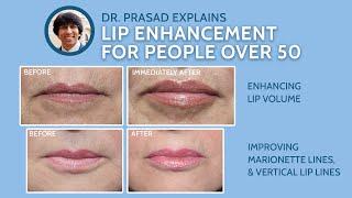 Why Lip Enhancement Over Age 50 Needs More than Lip Fillers