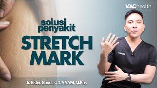 Stretch Mark Sulit Hilang? Ini Penyebab dan Cara Mencegahnya  Kata Dokter