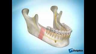 Osteotomia di arretramento della mandibola