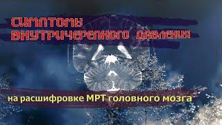 ЦЕРЕБРОВАСКУЛЯРНАЯ БОЛЕЗНЬ и признаки повышенного ВНУТРИЧЕРЕПНОГО ДАВЛЕНИЯ на расшифровке МРТ мозга