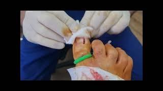 Performing a Wedge Resection For Ingrown Nails