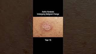 Skin Cancer Development Time Lapse Normal to Squamous Cell Carcinoma Over 25 Years