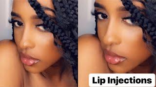 FAKE LIP INJECTIONS AT HOME how to get big lips