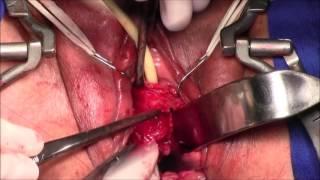 Urethrolysis complication