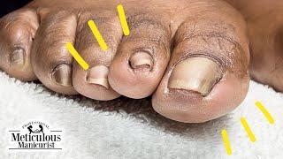 How to Fix Toenail Discomfort