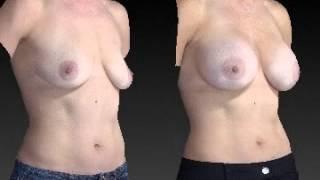 Breast Enhancement 14