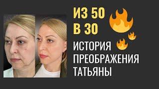 История пациентки. СМАС лифтинг блефаропластика платизмопластика липофилинг удаление комков Биша