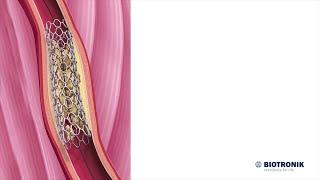 Angioplastik og stentning  Medicinsk animation