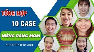 Tổng hợp 10 ca Niềng răng móm điển hình đã điều trị thành công tại nha khoa Thùy Anh - Phần 1