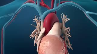 Coronary Angioplasty - Radial Access