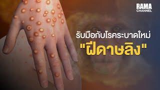 โรคฝีดาษลิง ติดง่ายไหม ป้องกันอย่างไร ?