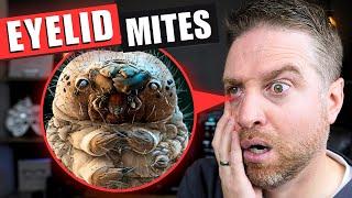 How to Get Rid Of Eyelid Mites That Cause Demodex Blepharitis