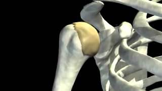 Shoulder joint dislocation