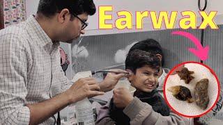 Earwax Removal from children  How to remove hard wax from small children  Video otoscaopy