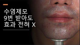 수염제모 9번 받아도 효과 전혀 X