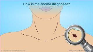 Diagnosing Melanoma