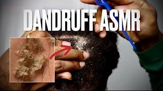 Dandruff Scratching ASMR  Removing Big Flakes From My Locs #dandruffremovalasmr #dreadlocksdandruff