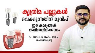 കൃത്രിമ പല്ലുകൾ വെക്കുന്നതിന് മുൻപ് ഈ കാര്യങ്ങൾ അറിഞ്ഞിരിക്കണം  Dental Implants  Health Tips