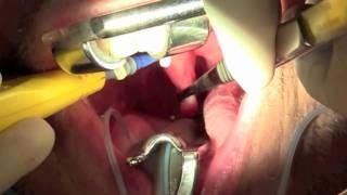 Uvula Excision for Snoring & Other Problems