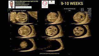 Kehamilan 9 weeks dgn mioma