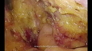 Laparoscopic Cystectomy Bricker