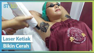 Mencerahkan Ketiak Gelap dengan Underarm Facial Laser Treatment di Klinik Kecantikan Aman & Ampuh