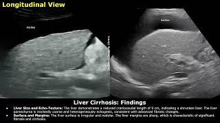 Liver Cirrhosis With Portal Hypertension Ascites & Splenomegaly Ultrasound Report Example  USG