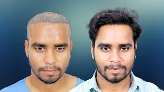 Hair Transplant In Bhopal  Best Cost & Result of Hair Transplant and Before After Hair Transplant