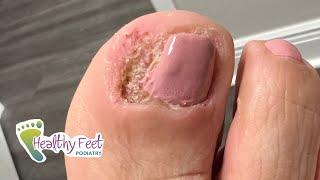DONT TREAT YOUR TOE NAIL AT HOME