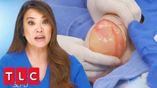 This Lipoma Is in “One of the Worst Possible Places”  Dr. Pimple Popper