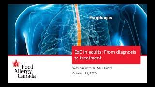 Webinar EoE in adults From diagnosis to treatment