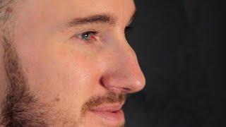 Five Minute Nose Job  Non-Surgical Rhinoplasty  Alex Henry