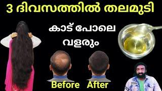 തലമുടി കാട് പോലെ തഴച്ച് വളരാൻ  Hair grows quickly