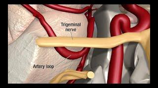 Treatment for Trigeminal Neuralgia UCSF Neurosurgery