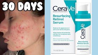 I TRIED THE CERAVE RESURFACING RETINOL SERUM FOR MY ACNE  1 Month Test