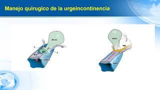 Teoria integral y manejo quirurgico de la urgeincontinencia