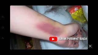 kok bisa memar setelah infus?? pengalaman subscriber