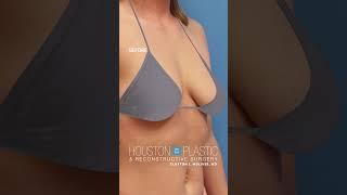 Breast augmentation before & after #breastaugmentationsurgery #breastimplantsurgery #plasticsurgery