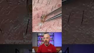  Ingrown Hair Alert  Watch as they conquer this gnarly skin invader #DermReacts #DoctorReacts