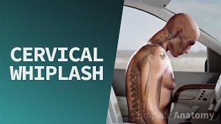 Cervical Whiplash  Trauma