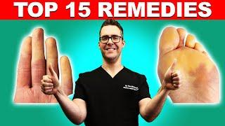 Raynauds Syndrome Top 15 Remedies Symptoms & Best Treatment