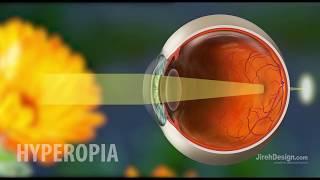 Hyperopia  Farsightedness Explained HD