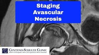 AVN avascular necrosis stages